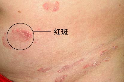 女性梅毒小红点早期症状图片