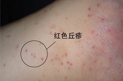 女性梅毒小红点早期症状图片