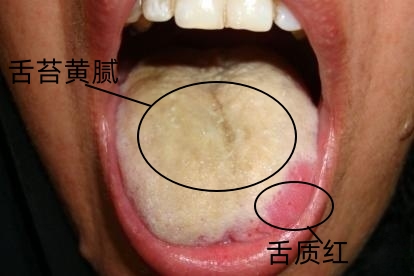 痿症图片