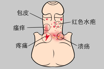 包皮疱疹的症状图片