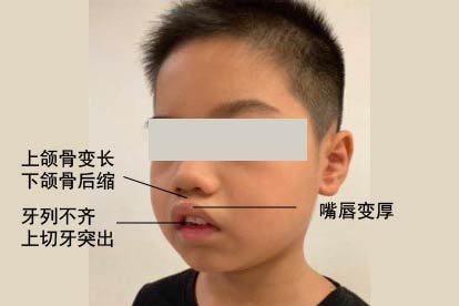 腺样体面容特征图片