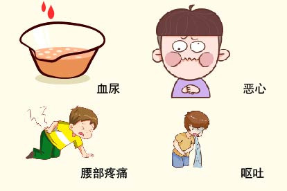 肾结石症状图片