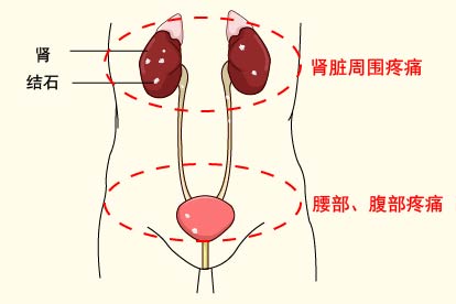 肾结石疼痛位置图片