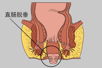 肛门过敏的症状图片