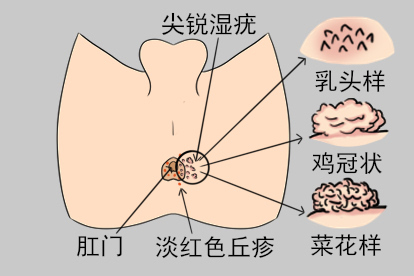 肛门菜花样病变图片