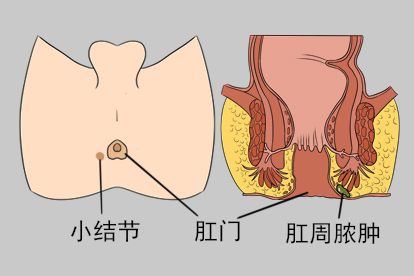 肛门起了个硬疙瘩图片