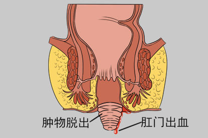 直肠脱垂什么症状图片
