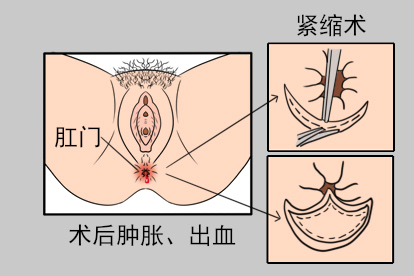 肛门紧缩术图片