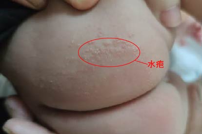 女性尾骨疱疹症状图