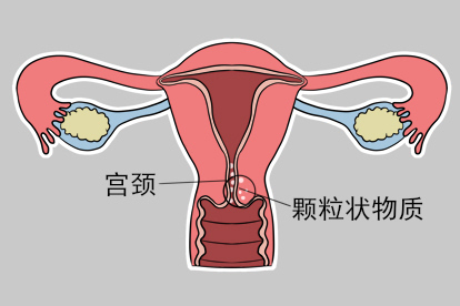 宫颈里面有小米粒生理性因素图