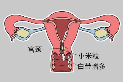 宫颈里面有小米粒宫颈炎图