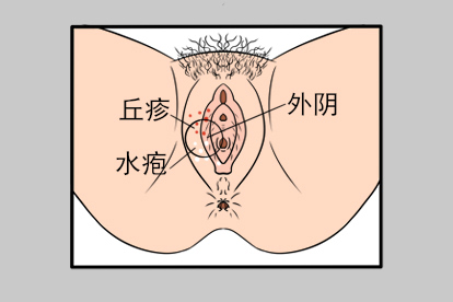 女性外阴长湿疹图片