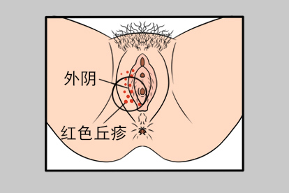 女性外阴长毛囊炎图片