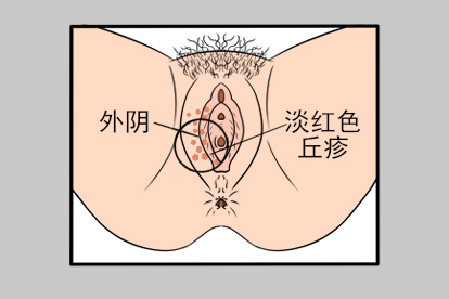女性外阴长尖锐湿疣图片