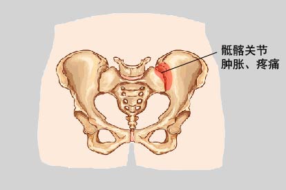 骶髂韧带损伤的症状图片