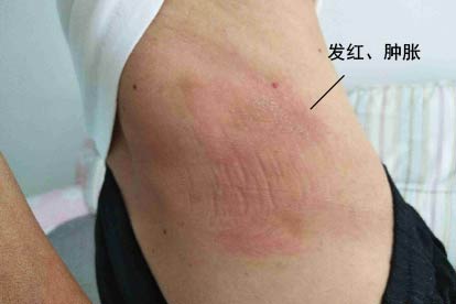 腰扭伤红肿图片