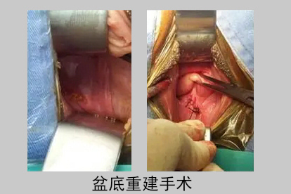阴道壁膨出盆底重建手术治疗图