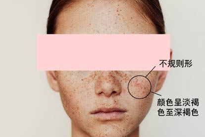 雀斑图片