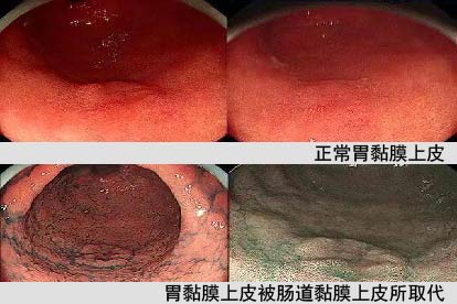 胃肠化图片