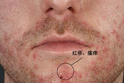 男性得了性病脸上症状图片