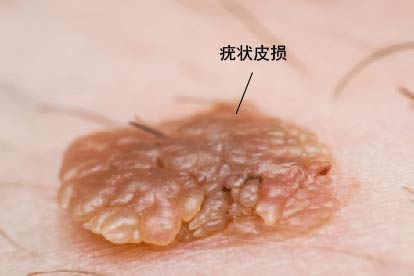 HPV感染的疣状皮损图片