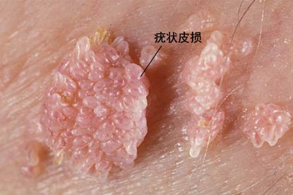 HPV感染的疣状皮损图片