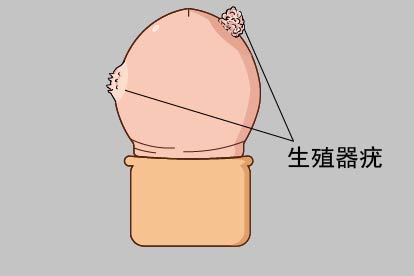 男性HPV感染的症状图片