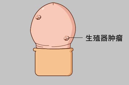男性HPV感染的症状图片