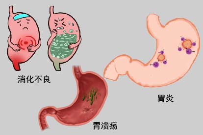 胃肠神经官能症病理因素图片
