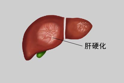 肝硬化图片