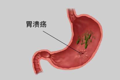 胃溃疡图片