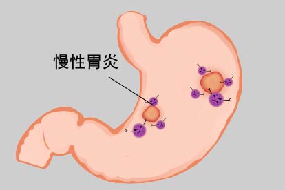 慢性胃炎图片