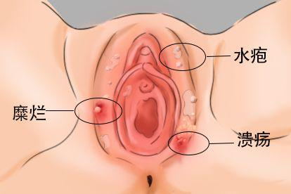 性疾病疱疹图片
