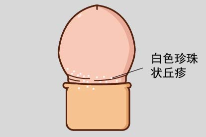 珍珠样阴茎丘疹图