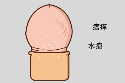 生殖器疱疹图