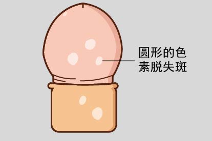 白色糠疹图