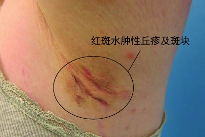汗腺炎图片