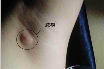 毛囊炎图片