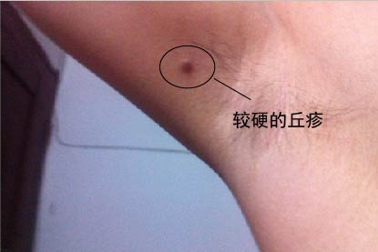寻常疣图片