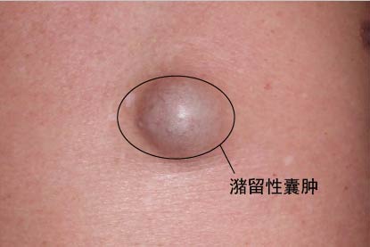 皮脂腺囊肿图片