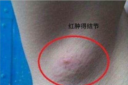 淋巴结肿大图片