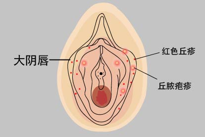 女性大阴囊唇内侧长了脓包图片