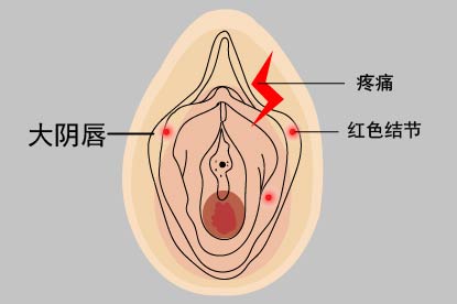 大阴唇疖图片