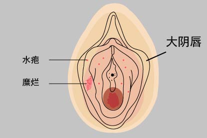 生殖器疱疹图片