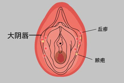 大阴唇脓疱病图片