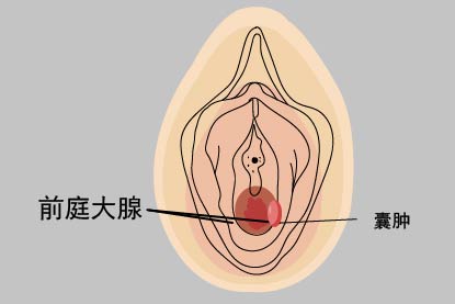 前庭大腺囊肿图片