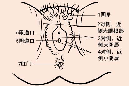 女性导尿术消毒顺序图