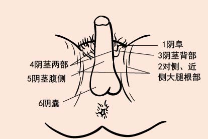 男性导尿术消毒顺序图