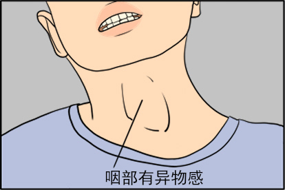 咽喉炎咽部异物感症状图片