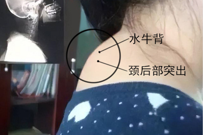 水牛背患者颈后部突出图片